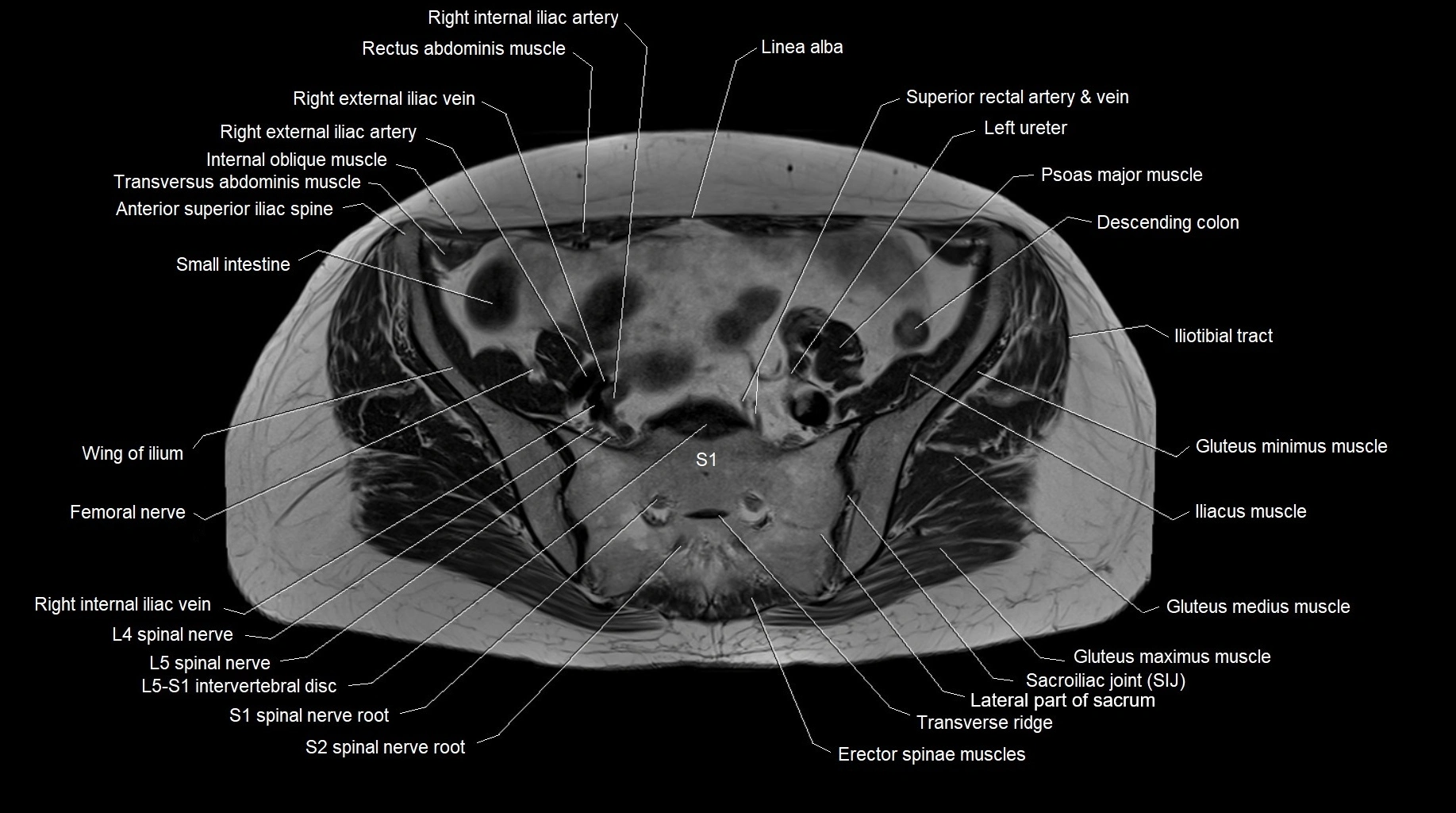 MRI 3T pelvis axial cross section anatomy image 11.webp